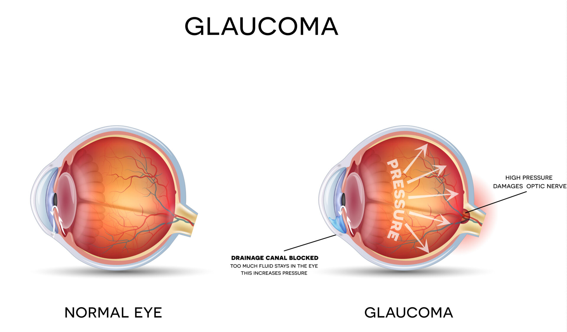 Early signs of glaucoma you shouldn't ignore.